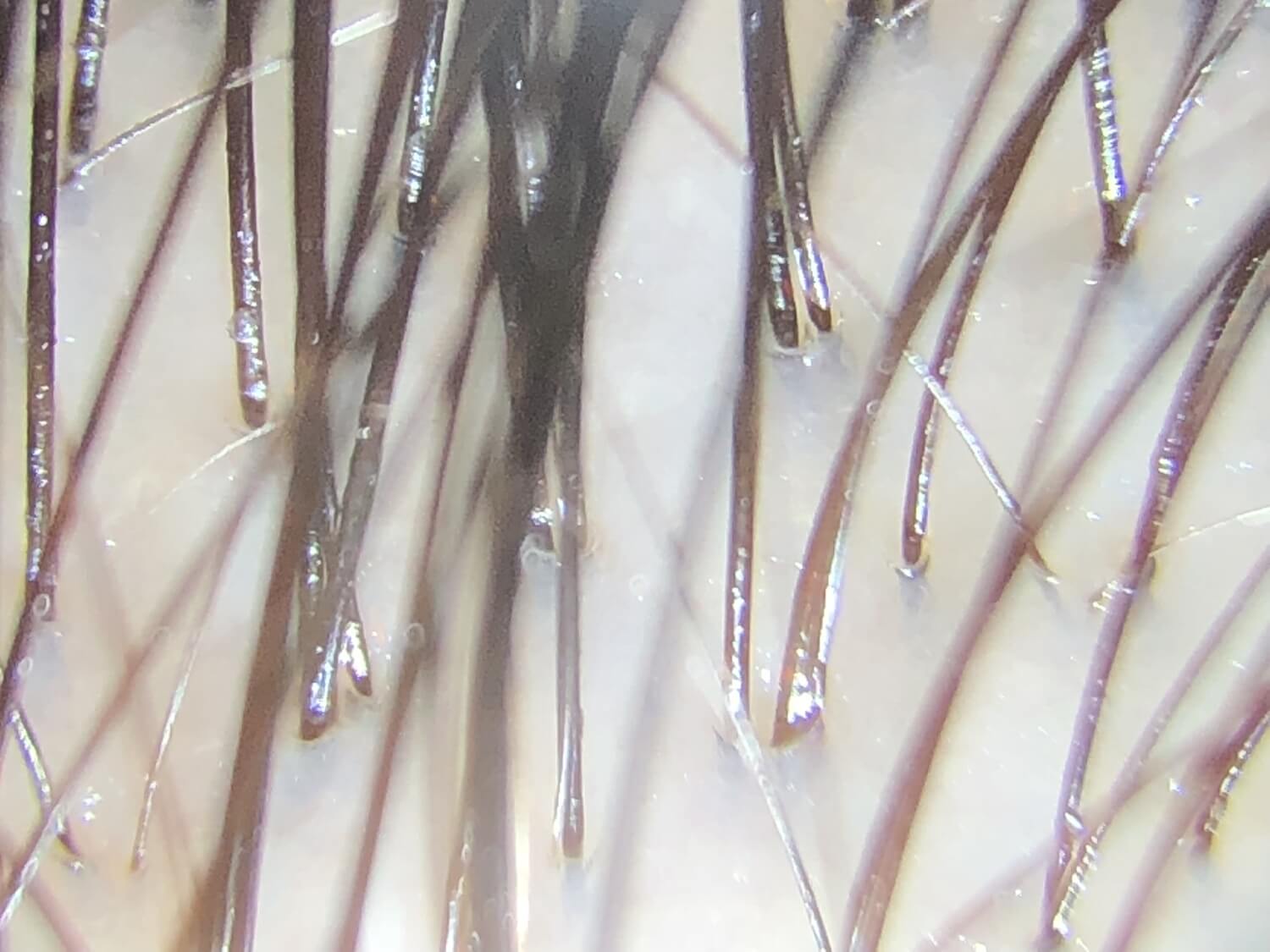 頭皮屑源於皮脂與角質問題