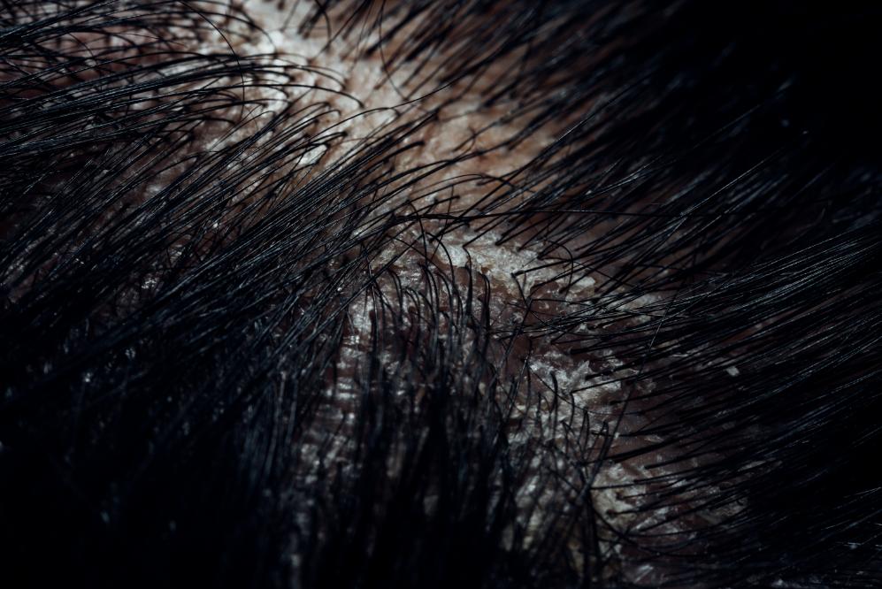 壓力大會造成頭皮出油