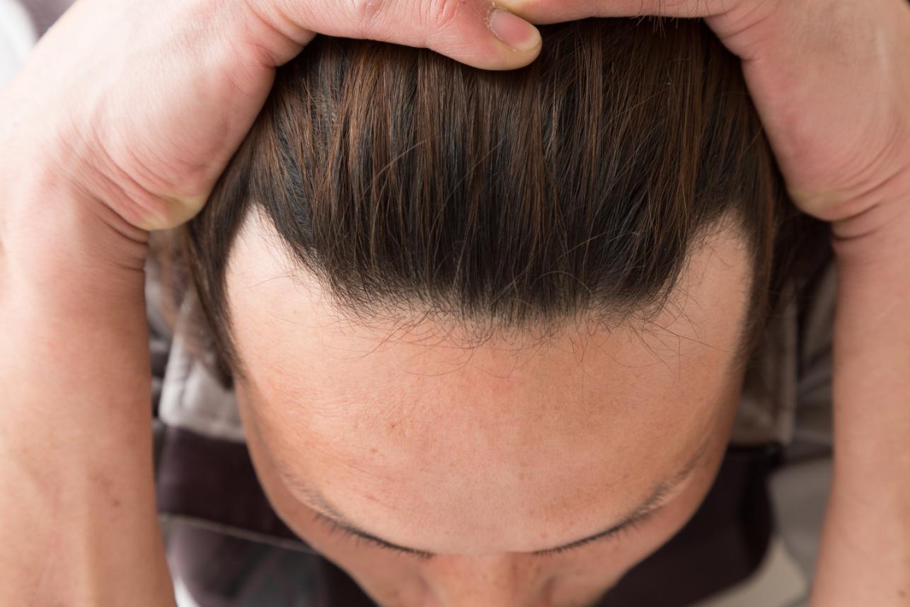 肉眼可看見頭頂有m型輪廓